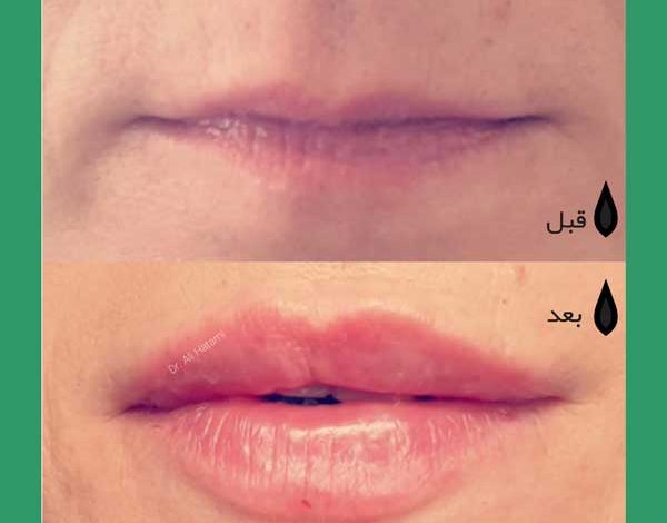 filer-lab تزریق ژل لب