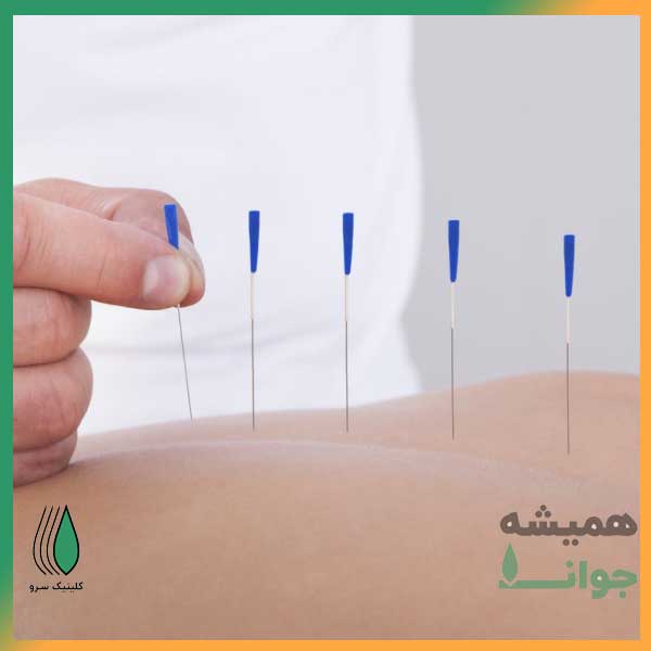 طب سوزنی Acupuncture